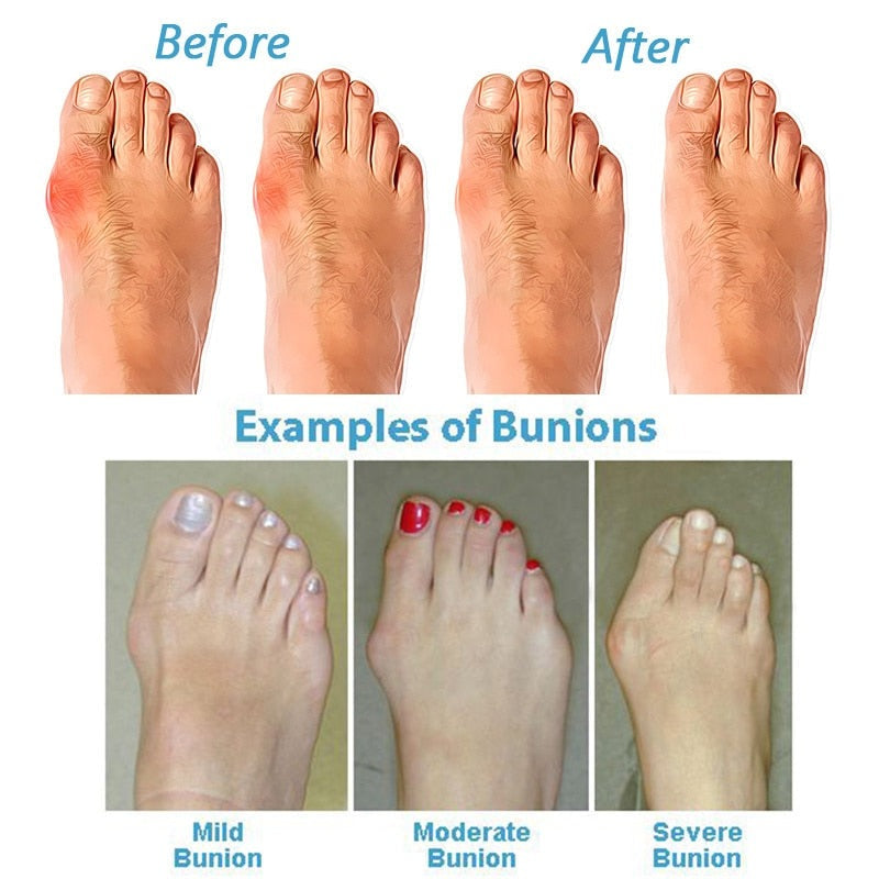 Women's Orthopedic Correcting Sandals - Stylish Supportive Footwear for Bunion Relief 7